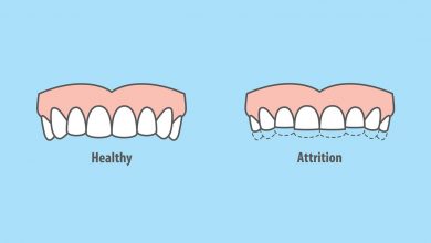 Photo of What Causes Teeth Clenching & Grinding?