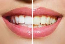 Photo of How to Whiten Teeth: A Complete Guide