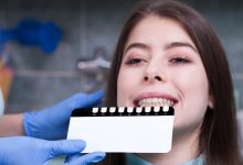 Photo of Dental Bonding vs Veneers: The Ultimate Guide
