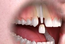 Photo of Dental implants and nerve damage, a study