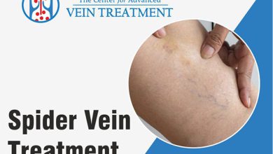 Photo of What To Do If You Or Your Loved One Suffers From Spider Vein?