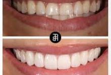 Photo of VENEERS VS. TEETH WHITENING: WHICH ONE IS BEST FOR YOU?