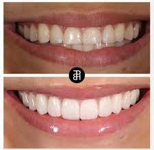 Photo of VENEERS VS. TEETH WHITENING: WHICH ONE IS BEST FOR YOU?