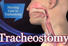 Photo of What are Tracheostomy Care Services?