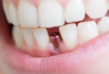 Photo of Is It Worth It? Dental Implants