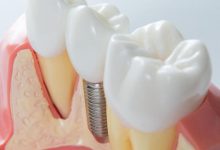 Photo of Dental Implants: How Much Do They Cost?