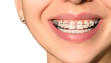 Photo of How Do Dental Braces Change Your Face