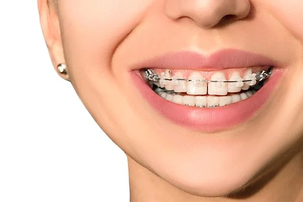 Photo of How Do Dental Braces Change Your Face